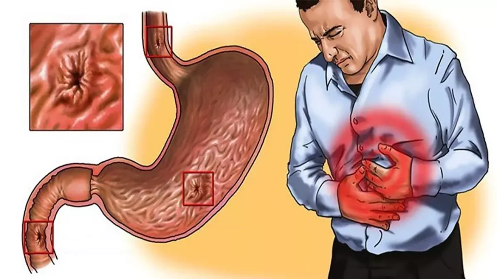 Gastritis - Gejala, Penyebab dan Cara Mengobati