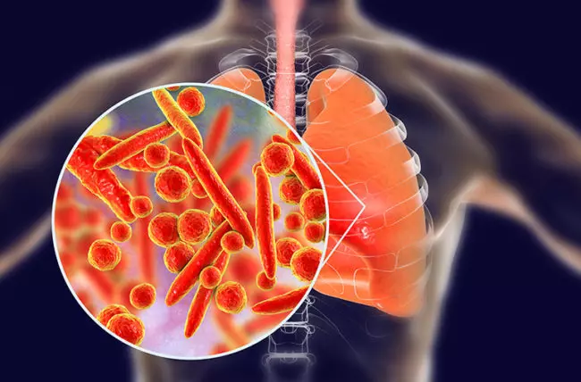 Mycoplasma Pneumonia – Gejala, Penyebab dan Cara Mengobati
