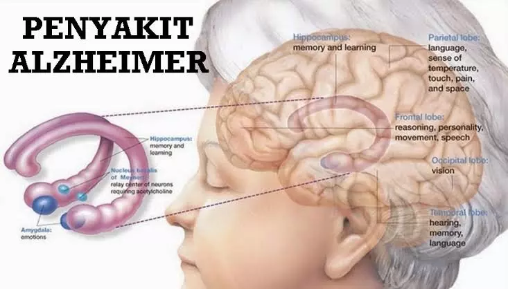 Penyakit Alzheimer - Gejala, Penyebab dan Cara Mengobati