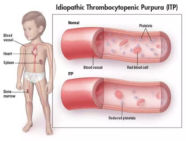 ITP (Immune Thrombocytopenic Purpura) – Gejala, Penyebab, dan Cara Mengobati
